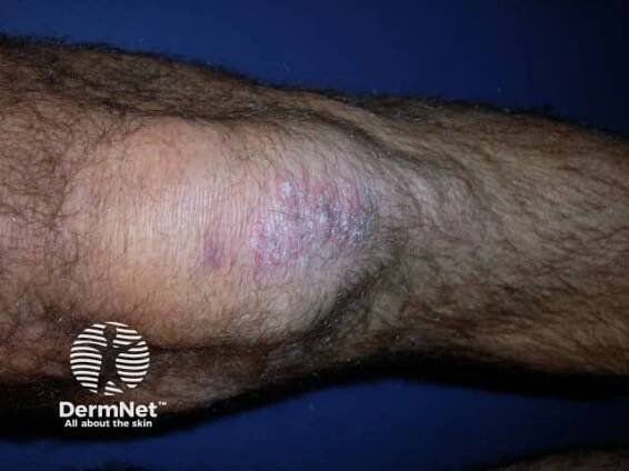 Chronic plaque psoriasis images — DermNet