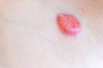 Zvýšený protuberans dermatfibrosarkomu (DFSP, non-melanom rakoviny kůže) na rameni hrudníku, které vytvořily červený pigment a pavoučí žíly, odstranitelné Mohs chirurgie — Stock obrázek