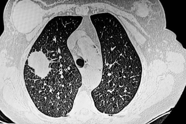 cat sken plic ukazující nádor adenokarcinomu - ct scan lung - stock snímky, obrázky a fotky