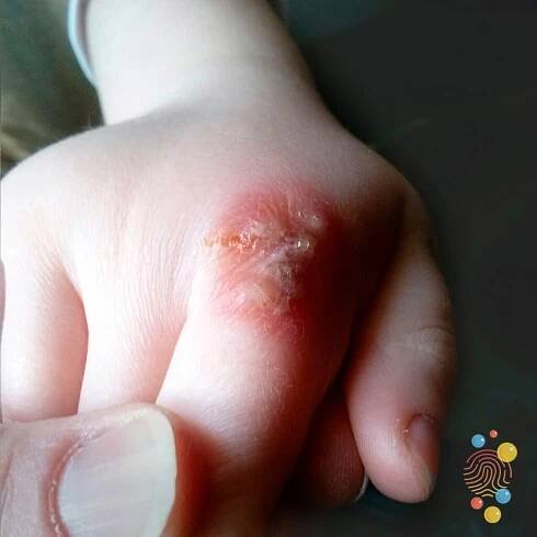 Crop of vesicles on the knuckle.
hands, herpes, herpes simplex, vesicular