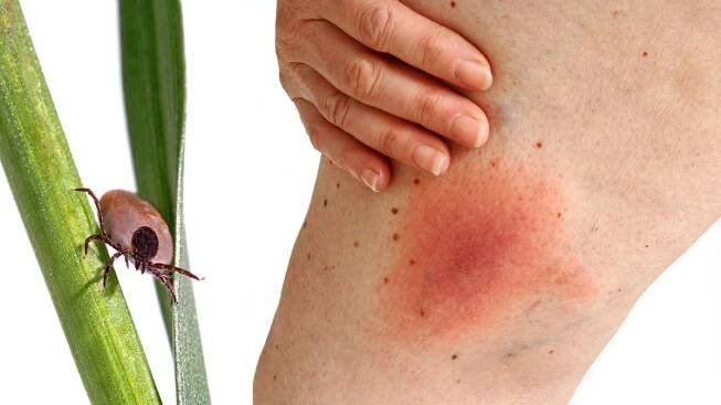 Klíšťová encefalitida a lymeská borrelióza. Jaký je mezi nimi rozdíl, příznaky a prevence