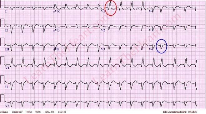 Blokáda pravého raménka Tawarova - EKG | Medicína, nemoci, studium na 1. LF UK