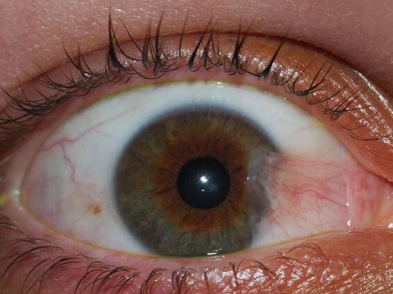 Pterygium
