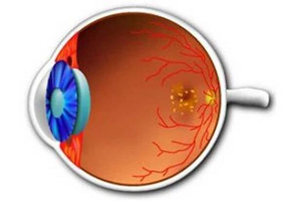 Dystrofie sítnice / Retina