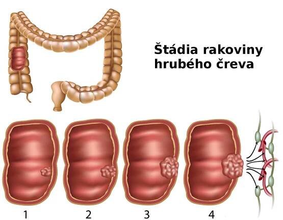 Rakovina tlustého střeva - stádia