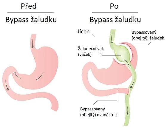 Žaludeční bypass – co je to a kdy se provádí
