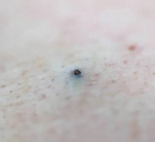 Černý pupínek akné na lidské kůži, pozadí. Léčba akné a akné, kosmetika, hygiena — Stock fotografie