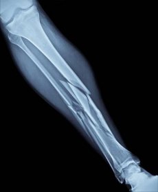 rentgen zlomené nohy - lýtkovým kostem - stock snímky, obrázky a fotky