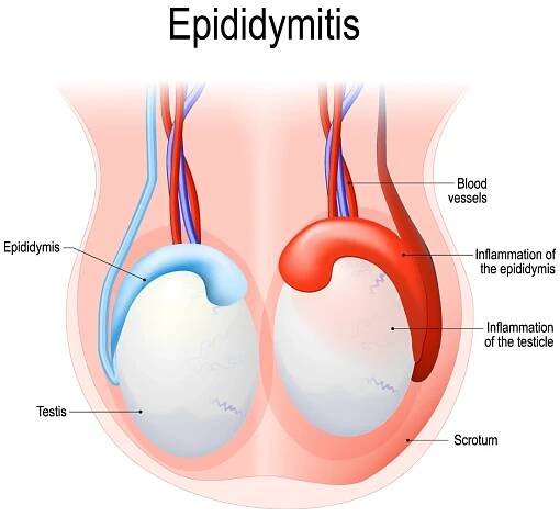 Epididymitis | Aurora Health Care