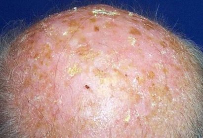 Picture of Solar Keratosis