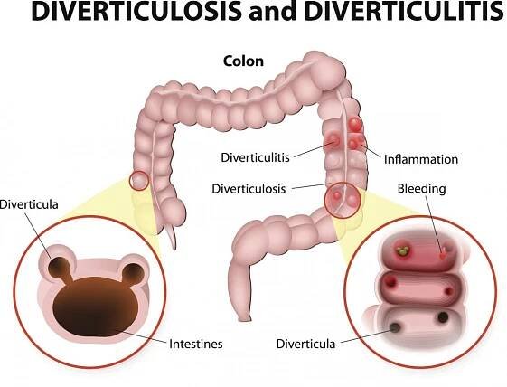 Diverticulosis Homeopathy Treatment in Zirakpur