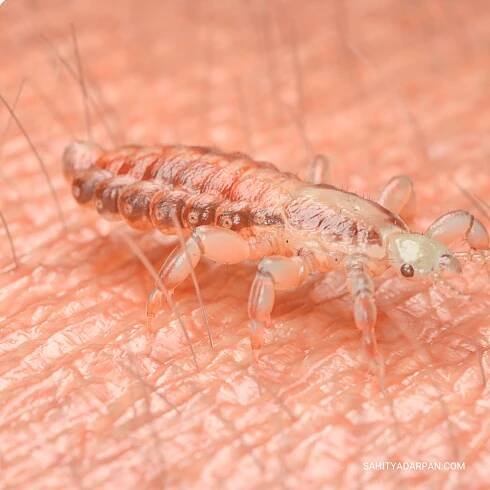 pubic lice
