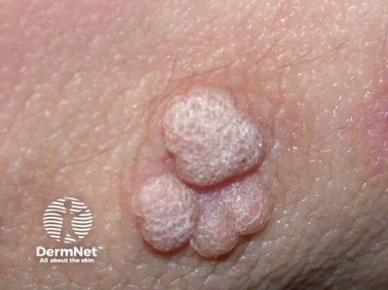 Warts, verrucas, human papillomavirus infection