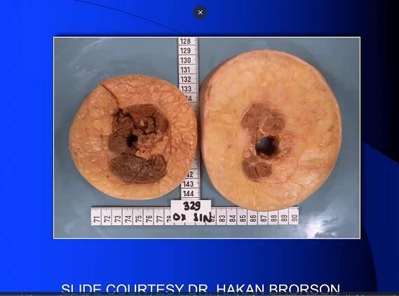 Fat hypertrophy from lymphedema