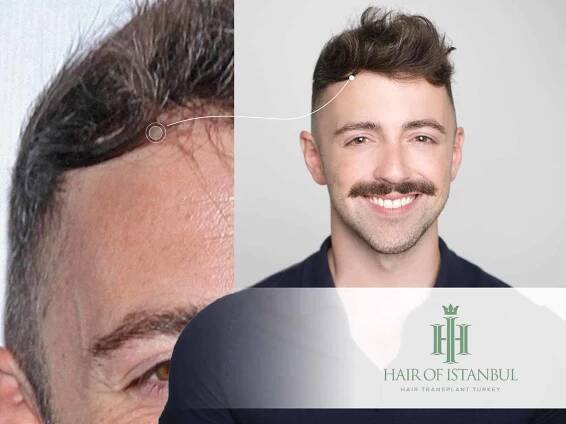 Matteo Lane Hair Transplant: The Real Story Uncovered