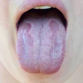 orální kandidóza nebo orální trush ( candida albicans), kvasinková infekce na lidském jazyku zblízka, běžný vedlejší účinek při použití antibiotik nebo jiných léků - candida parapsilosis - stock snímky, obrázky a fotky