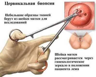 Cervikální dysplázie / Gynekologie | Užitečné informace a tipy na péči o sebe. Zdraví, výživa a další.