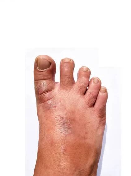 Lidské nohy jsou plísňové kožní léze izolované na bílém pozadí, atleti nohy, dermatofyty nebo Tinea pedis, candida albicans — Stock obrázek