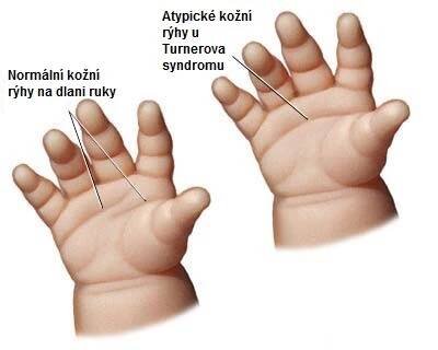 turneruv-syndrom-metakarp