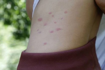 Red, swollen and itchy spots on skin caused by insect bites or allergy. Skin reaction to insect bites.