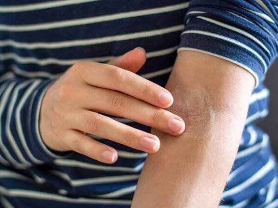 What Causes Dry White Patches on Skin?