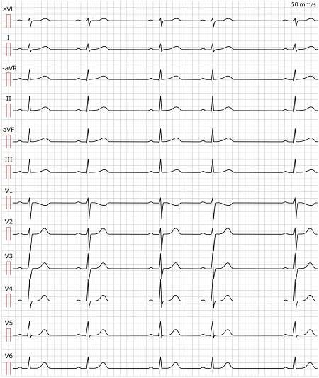 Abbildung 1. Sinusarrhythmie (Respiratorische Sinusarrhythmie).