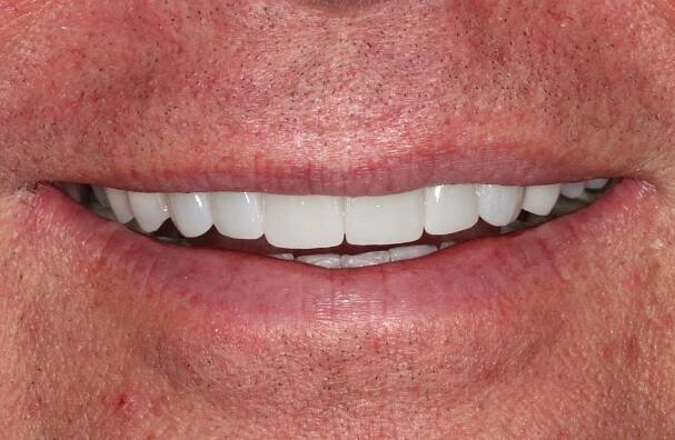 Before & After Cases | Dr. Timothy F. Kosinski in Bingham Farms, MI