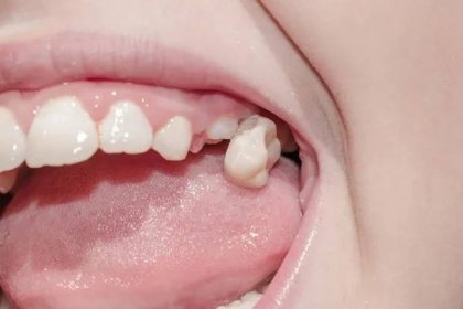 Primární zuby mléka padají na černou, nakaženou karí pro medicínu — Stock obrázek