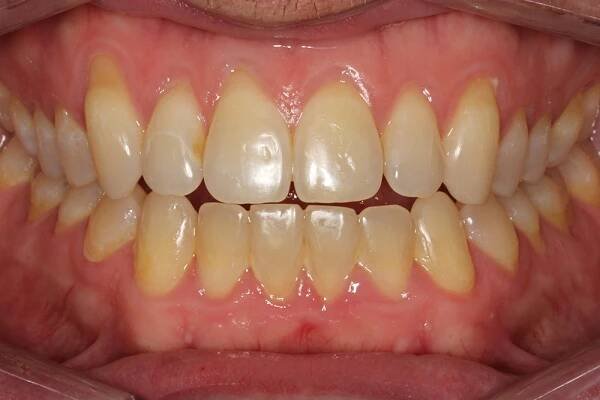Before and After • 425 Dental