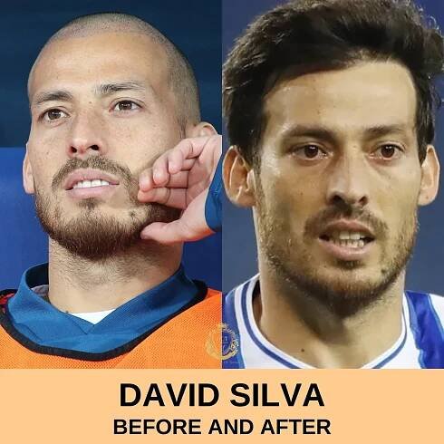 David Silva Hair Transplant - Hair Transplant in Turkey Istanbul - Hair Center of Turkey