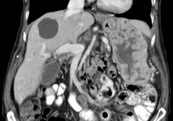 Ménétrier's disease - Wikipedia