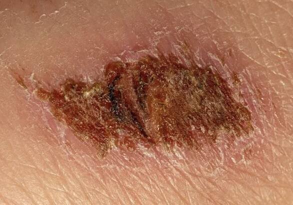 Scab.png