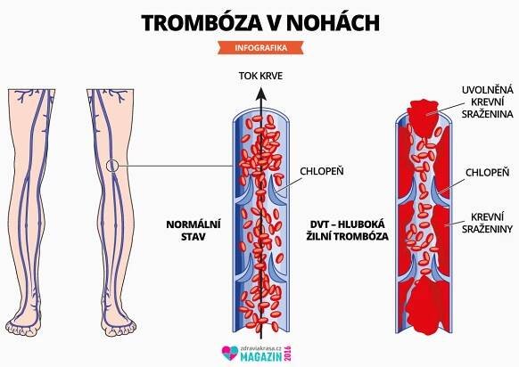 Trombóza vzniká většinou v končetinách, nejčastější v nohách.