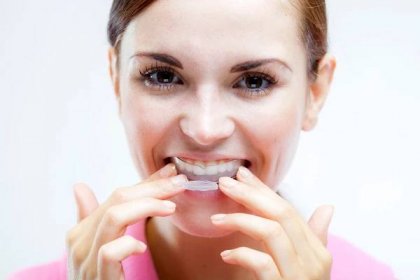 Křivé zuby – příčiny a možná náprava - Ženský element