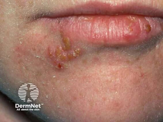 Herpes Simplex Images
