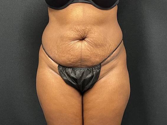 Lipo #6 – Plastic Surgery Services in Charlotte, NC