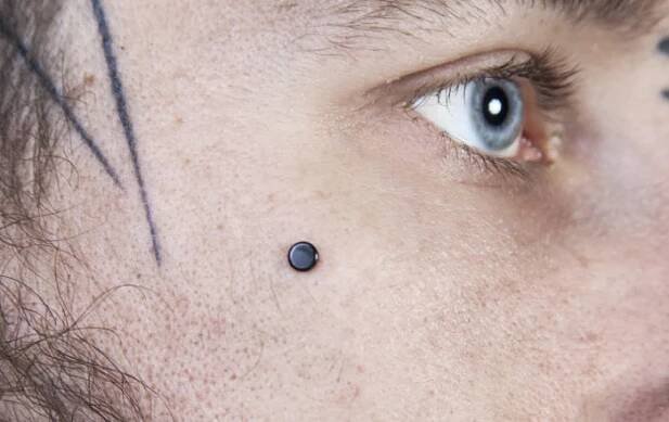 microdermal2