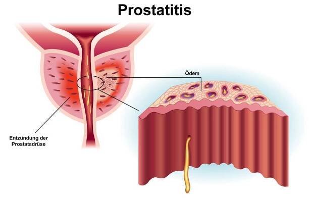 Prostataentzündung Prostatitis