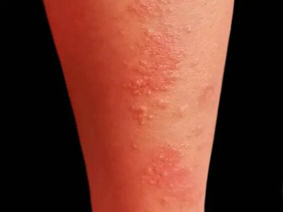 Herpes simplex infekce na noze asijského muže. Malé a bolestivé váčky. Izolováno na černé. — Stock obrázek