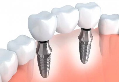 Diagram of an integrated dental implant in Brownstown