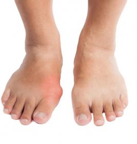 Dvojice nohou s deformovaný pravý palec kvůli bolestivé dnu zánětu. — Stock fotografie