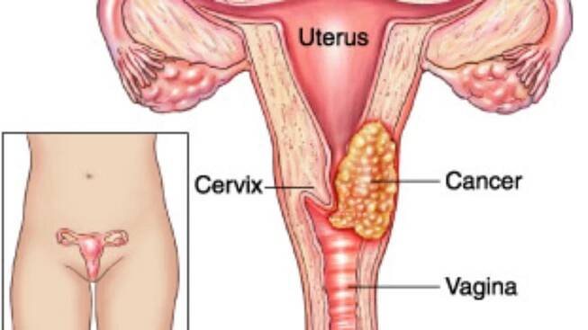 Každoroční gynekologické prohlídky, testování na HPV a vakcinace proti HPV mohou u nás ročně zachránit před rakovinou děložního čípku až 300 žen a zabránit 800 nových případů (dle NZIP).