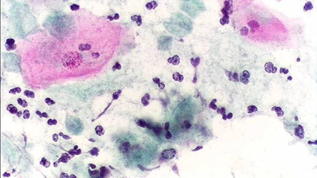 Trichomonas vaginalis