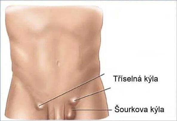 Tříselná kýla – Palas Athena
