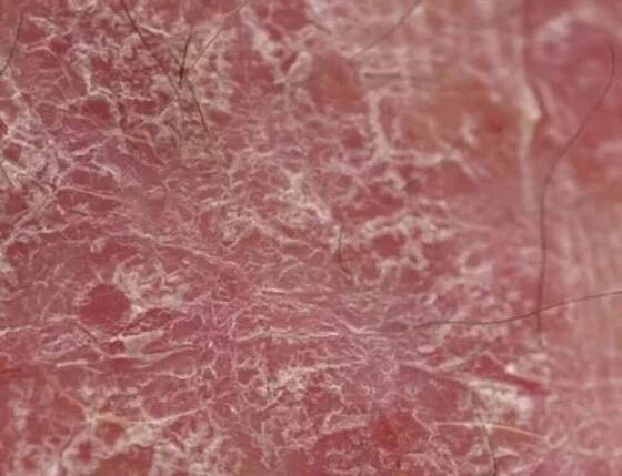 Treatments for Vitiligo: Science Communities Weigh In