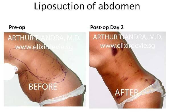 Liposuction Case Studies by Dr Arthur Tjandra of L’Élixir de Vie