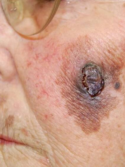 Skin Cancer