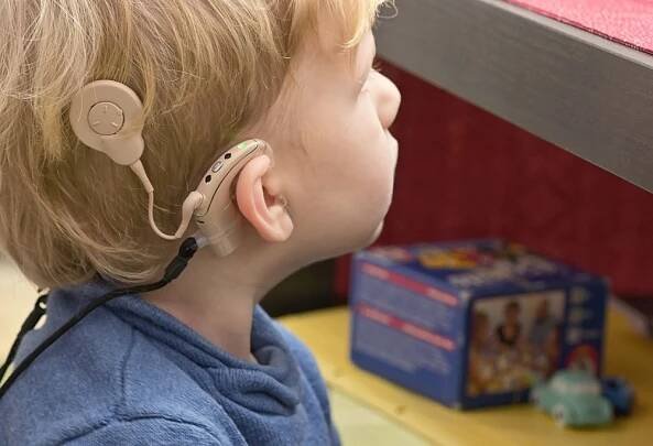 How Much Does Cochlear Implants Cost?