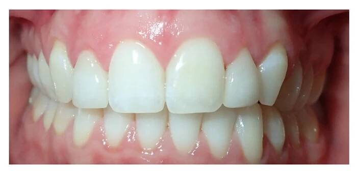 Invisalign and Veneers after