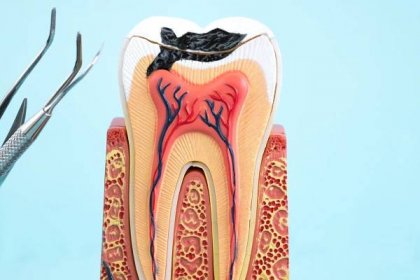 What Happens When We Receive A Root Canal?